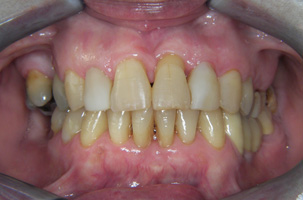Περιοδοντική νόσος με μετακινήσεις δοντιών. Περιοδοντική-Ορθοδοντική-Προσθετική θεραπεία