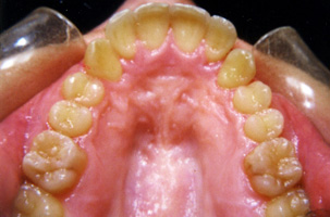 Υπερκάλυψη των κάτω προσθίων δοντιών