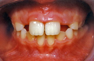 Διάστημα μεταξύ των επάνω δοντιών - Ορθοδοντικός Δρ. Ζαρμπή